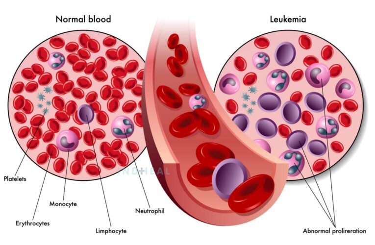 All You Must Know About Blood Most cancers