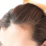 Tips While Choosing The Best Hair Transplant Clinic